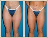 liposuction