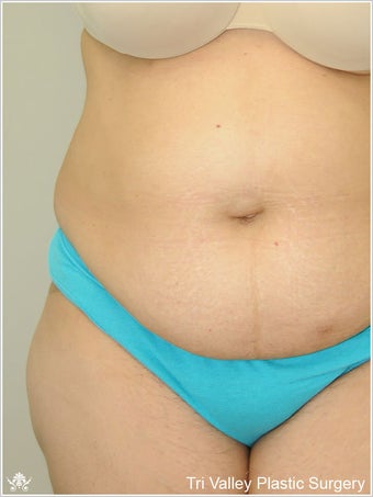 Liposuction
