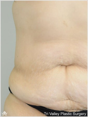 Liposuction