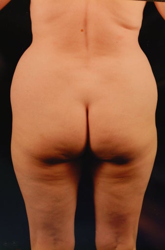 Liposuction