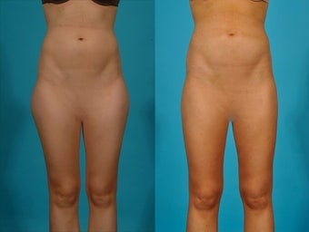 Liposuction
