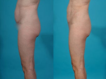 Liposuction; abdomen