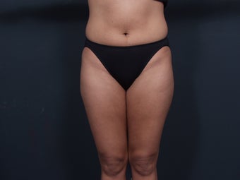 Liposuction