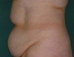 Lipo to Tummy