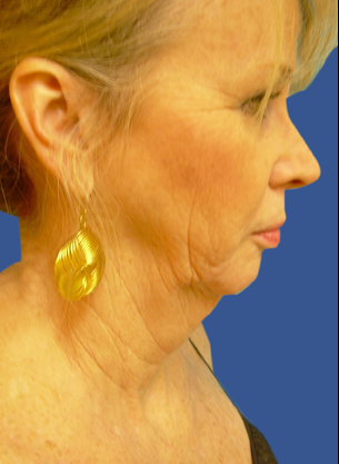 Jawline / Neck Lipo