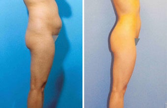 Liposuction