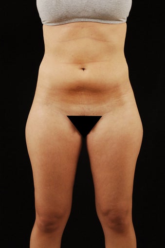 Liposuction