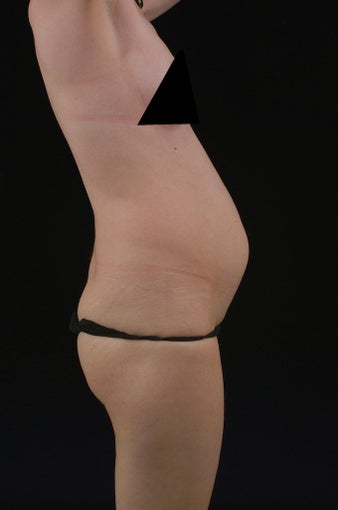 Liposuction