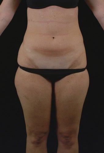 Liposuction