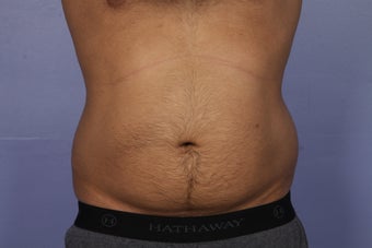 Liposuction