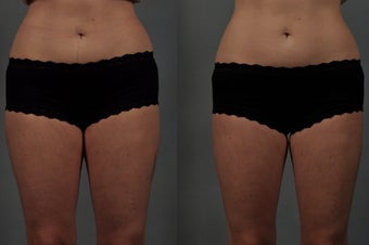 CoolSculpting of the Inner Thighs