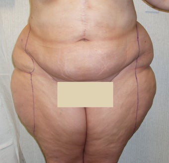 Liposuction Abdomen and Thighs