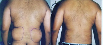 Liposuction Love Handles