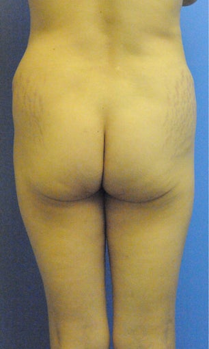 Liposuction and Abdominoplasty 
