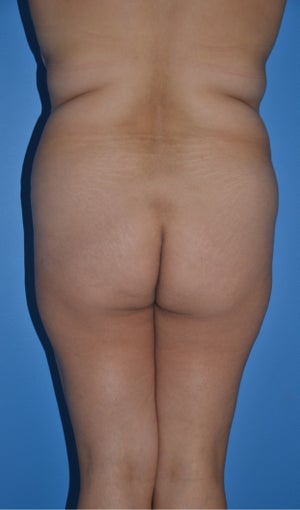Liposuction and Abdominoplasty