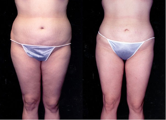 Liposuction