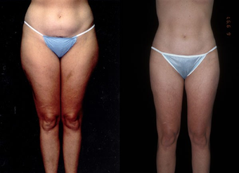 Liposuction