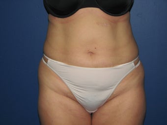 Liposuction
