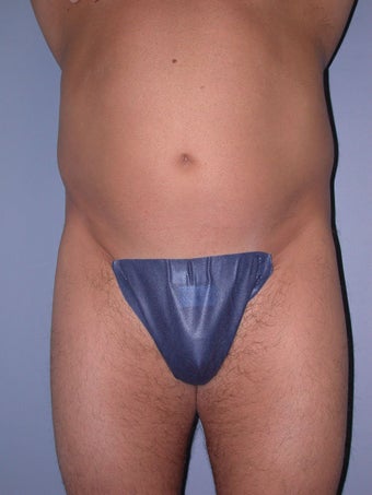 Liposuction