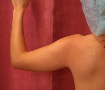 liposuction of arms for women
