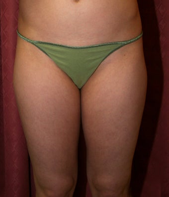 liposuction of thighs for women