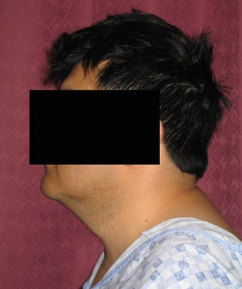Liposuction of neck & jaw line for men