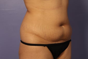 Liposuction