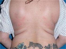 Liposuction 