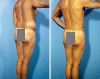 Liposuction