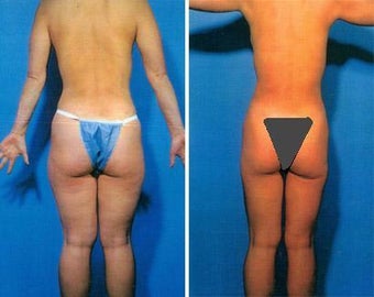 Liposuction