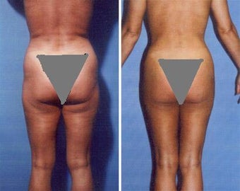 Liposuction