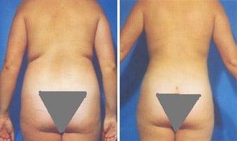 Liposuction