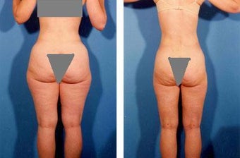 Liposuction