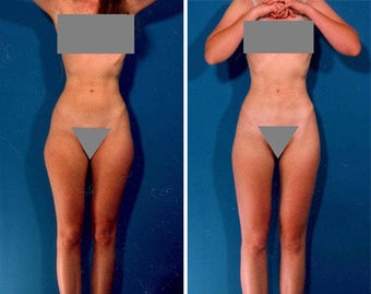Liposuction