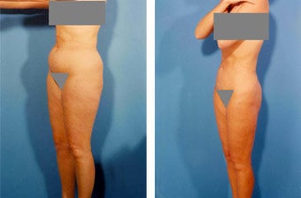 Liposuction