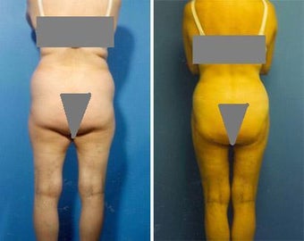 Liposuction