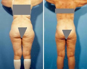Liposuction
