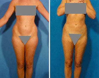 Liposuction