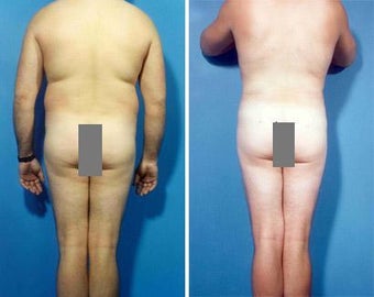 Liposuction