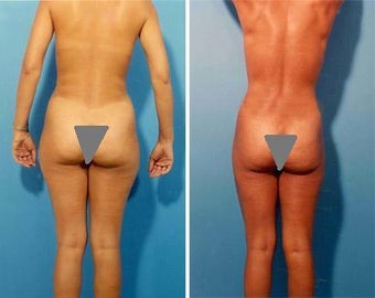 Liposuction