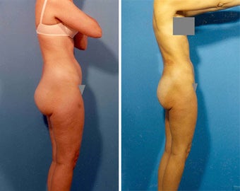 Liposuction