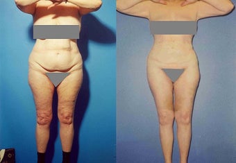 Liposuction