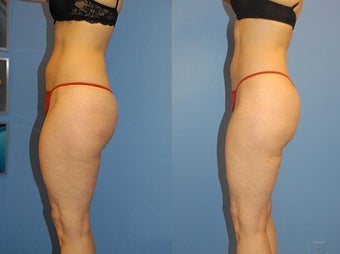 Liposuction