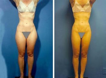 Liposuction