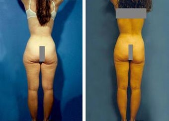 Liposuction