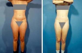 Liposuction