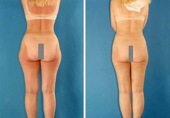 Liposuction