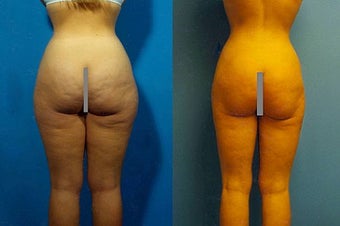 Liposuction