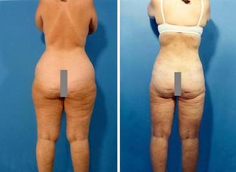 Liposuction