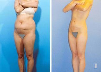 Liposuction
